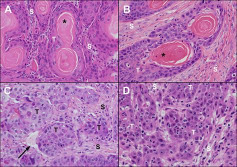 Oral Squamous Cell Carcinoma Histology