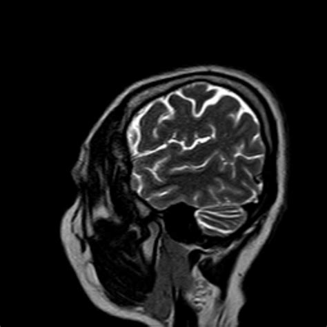 Radiopaedia Case Craniopharyngioma Nos Id Study Nc Commons