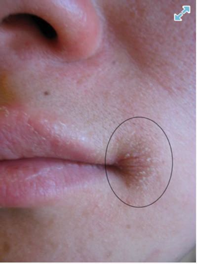 Angular Cheilitis Causes And Treatments