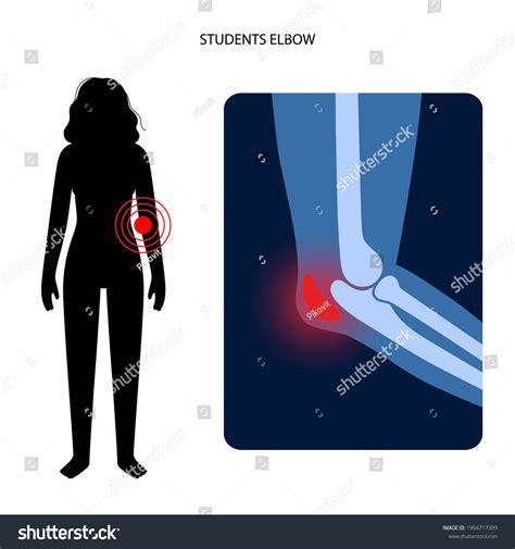 100 Elbow Bursa Anatomy Images Stock Photos Vectors Shutterstock