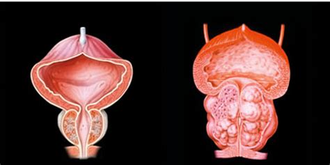 Prostatakarzinom Uroonkologisches Zentrum Klinikum Stuttgart