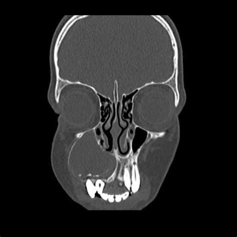 Maxillary odontogenic keratocyst – Artofit