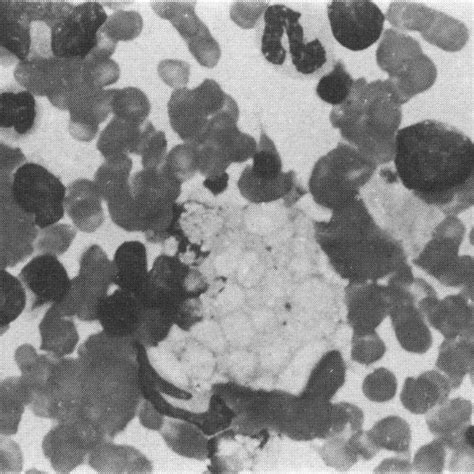 Foamy Macrophage In Bone Marrow Aspirate From Npcaffected Cat