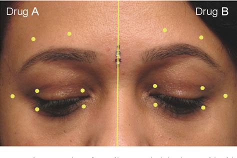 Figure 1 From Comparison Of Safety And Efficacy Of Botox And Neuronox