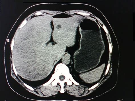 脂肪肝CT影像表现 医学影像图 医学图库