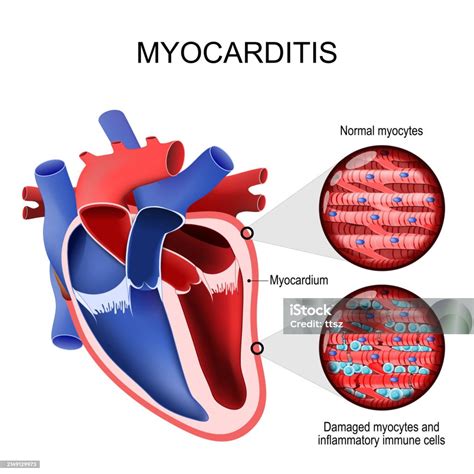 Myocarditis Inflammatory Cardiomyopathy Cross Section Of A Human Heart