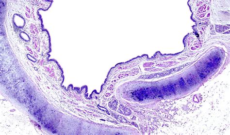 Squamous Metaplasia Of Bronchial Mucosa Photograph By Nigel Downer