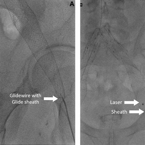 A A Glidewire With A Glide Catheter Used To Engage The Terminal