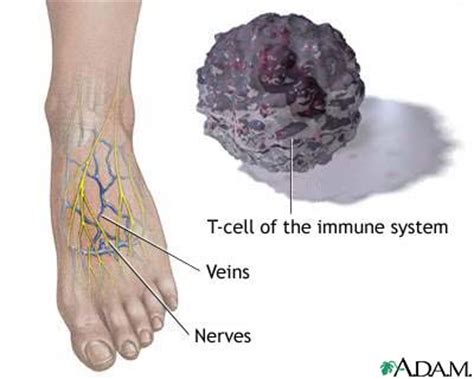 Do you suffer from Diabetic foot numbness? | Diabetes Healthy Solutions