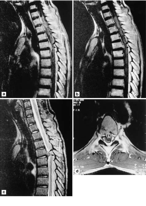 A Precontrast And B Postcontrast Sagittal Spin Echo T Weighted Mr