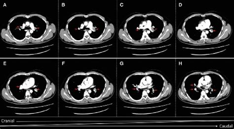 Figure 1 From Acute Pulmonary Thromboembolism In The Context Of Outing