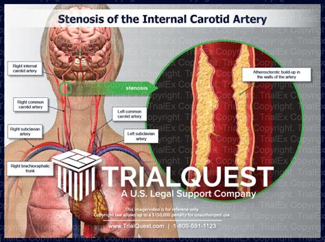 Stenosis of the Internal Carotid Artery - TrialExhibits Inc.