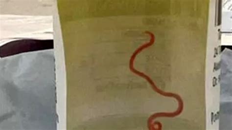 Le trovano un verme di 8 centimetri (vivo) nel cervello