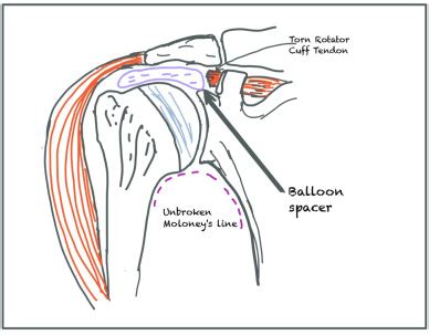 Subacromial Balloon Spacer Where Are We Now Journal Of Clinical