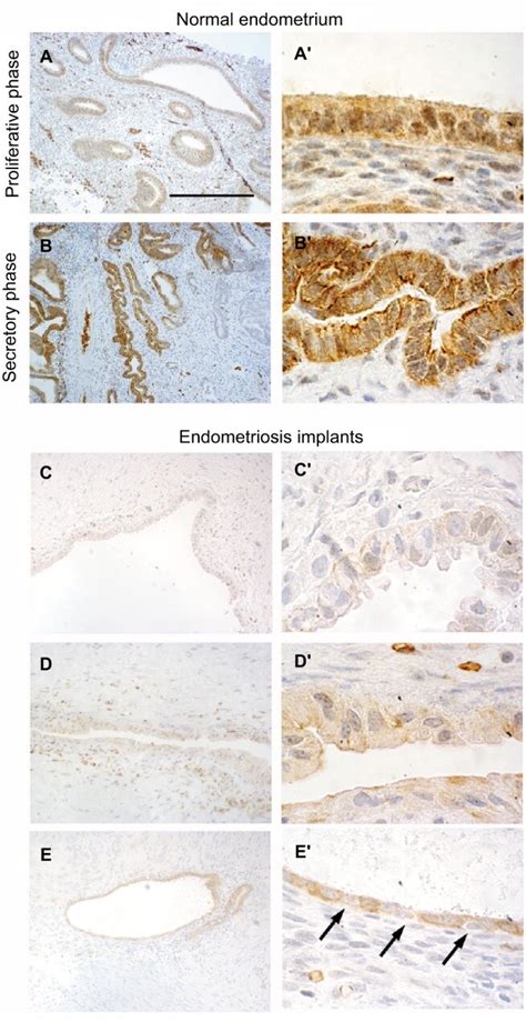 Immunohistolocalization Of DLX5 In Normal Endometrium And Ovarian