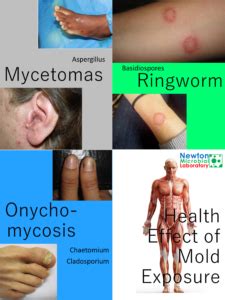 Mold Exposure Symptoms – Newton Microbial Laboratory