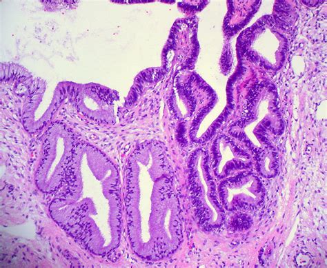 Cervix Adenocarcinoma In Situ Ed Uthman Flickr