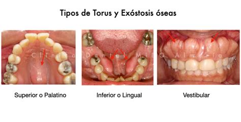 Todo lo que debes saber sobre Torus Qué son tipos y tratamiento