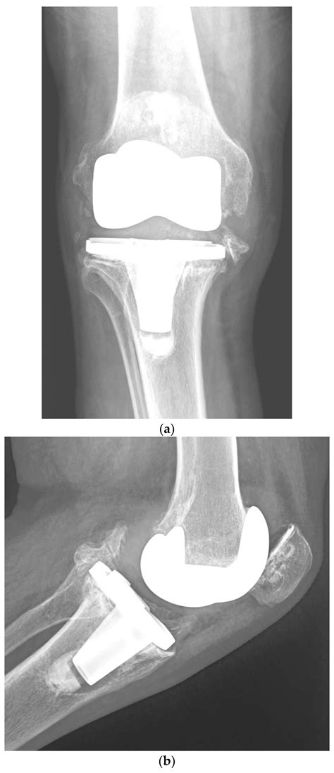 Jcm Free Full Text Risk Factors For Periprosthetic Joint Infection