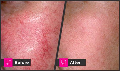 Facial Veins Rosacea Archives Main Line For Laser Surgery In Ardmore Pa