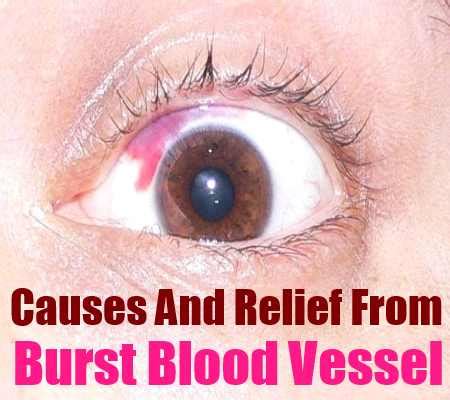 Causes And Relief From Burst Blood Vessel – Natural Home Remedies & Supplements