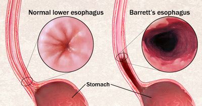 Barrett S Oesophagus Med Health Net