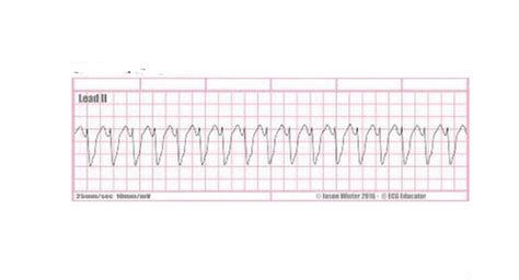 🤲🤯EKG: PVC, V-Tach, Unifocal PVC, Multifocal PVC, Couplet, Ventricular bigeminy, Ventricular ...