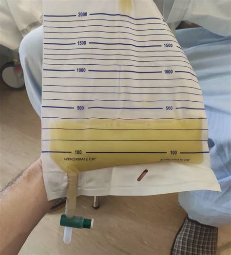 Chylous Ascites On Abdominal Drainage Download Scientific Diagram