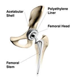 DePuy ALTRx Hip Replacement | Cleveland Injury Firm