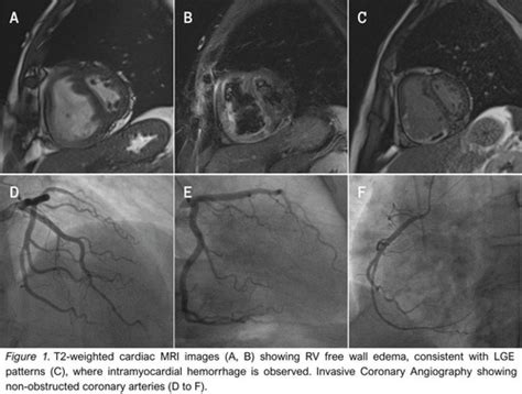 UNRAVELING AN ISOLATED RIGHT VENTRICULAR INFARCTION MYSTERY A MINOCA