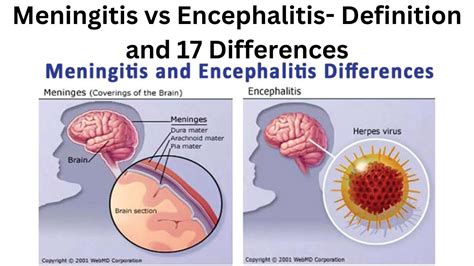 Meningitis Vs Encephalitis Definition And Differences Youtube