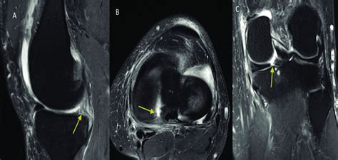 Left knee MRI showing a medial meniscus posterior root tear (MPRT)... | Download Scientific Diagram