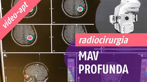 Radiocirurgia Para Mav Profunda Youtube