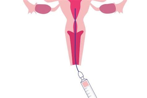 Artificial Insemination Everything You Need To Know Wistim Fertility