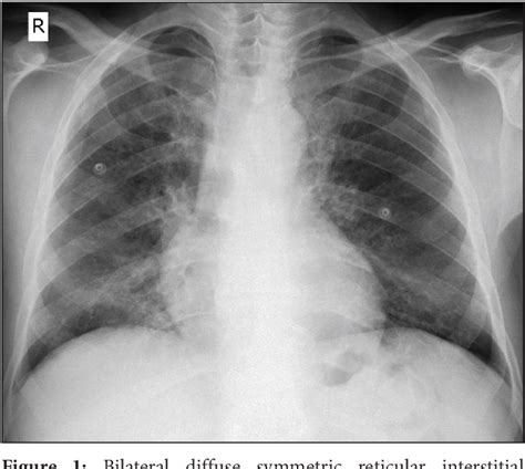 Figure 1 From Pneumocystis Jirovecii Pneumonia In Newly Diagnosed Hiv Infection A Challenging