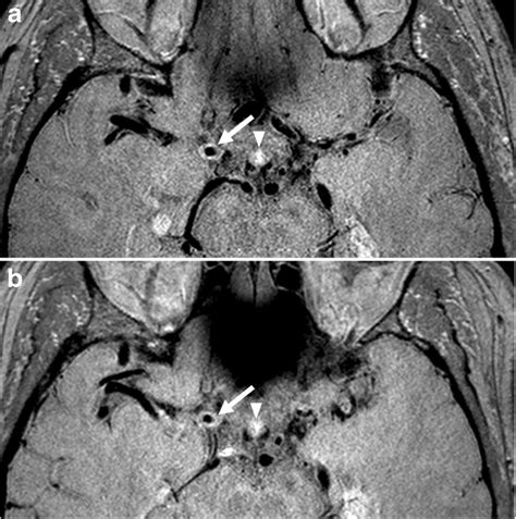 Persistent Grade Enhancement Of A Culprit Plaque In The Supraclinoid