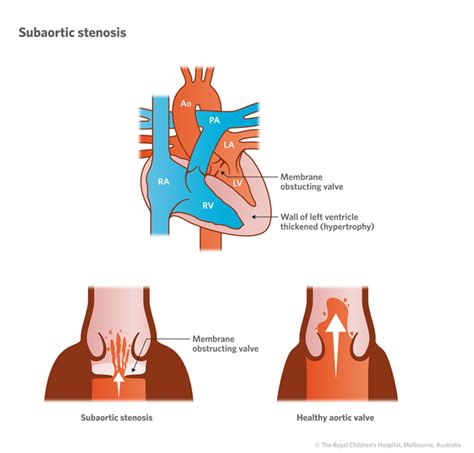 Aortic Stenosis Prognosis