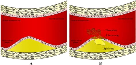 Progression Of Atherosclerotic Plaque A Atherosclerotic Plaque Formed