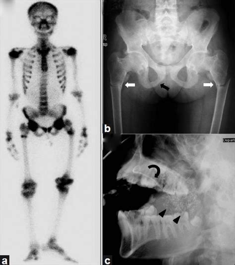 A Bone Scan Image Shows Diffuse Increased Tracer Uptake In The Entire