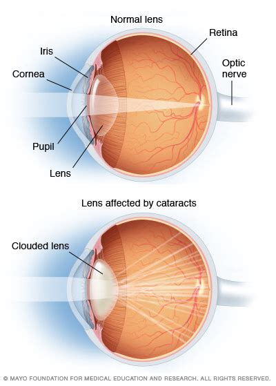 Cataract Surgeries On The Rise As Boomers Age Mayo Clinic News Network