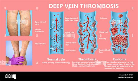 Thrombose veineuse profonde Banque de photographies et dimages à haute