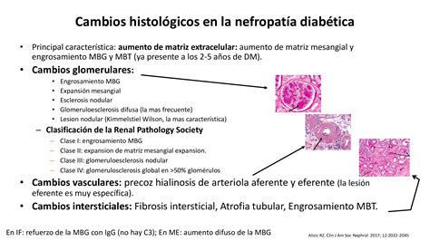 Afectaci N Renal En La Diabetes Mellitus Nefrolog A Al D A