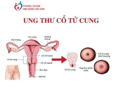 Ung thư cổ tử cung: Nguyên nhân, triệu chứng và điều trị - Phòng Khám ...