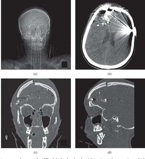 Figure From Delayed Tension Pneumocephalus Following Gunshot Wound To