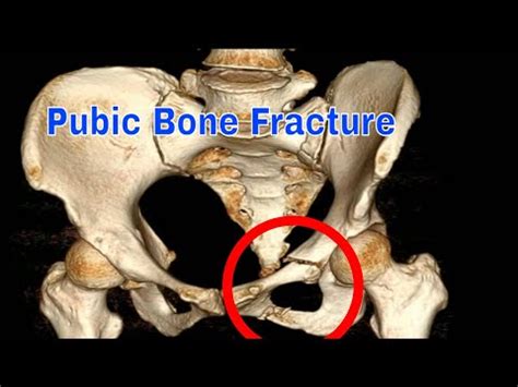 Pubic Ramus Bone Fracture