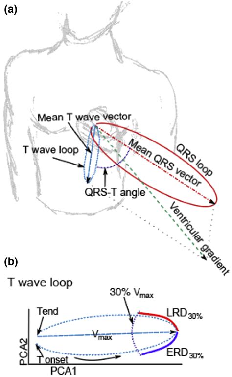 The Diagnostic Role Of T Wave Morphology Biomarkers In Congenital And Acquired Long Qt Syndrome