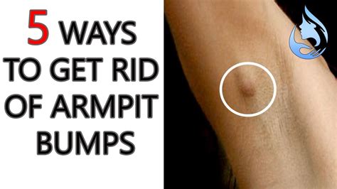 How To Get Rid Of Bumps On Back Of Arm At Lola Fowler Blog