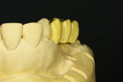 Wax Up F R Bohrschablone Ct H Lsen Camlog Zahntechnisches