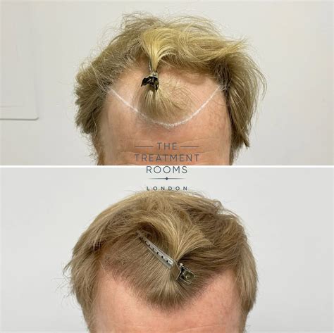 Fue Transplant Before And After Treatment Rooms London