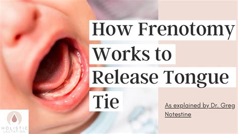 How Frenotomy Works To Release Tongue Tie Youtube